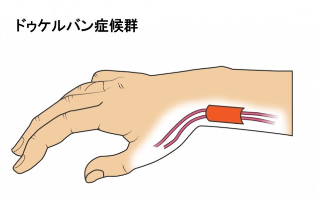 腱鞘炎